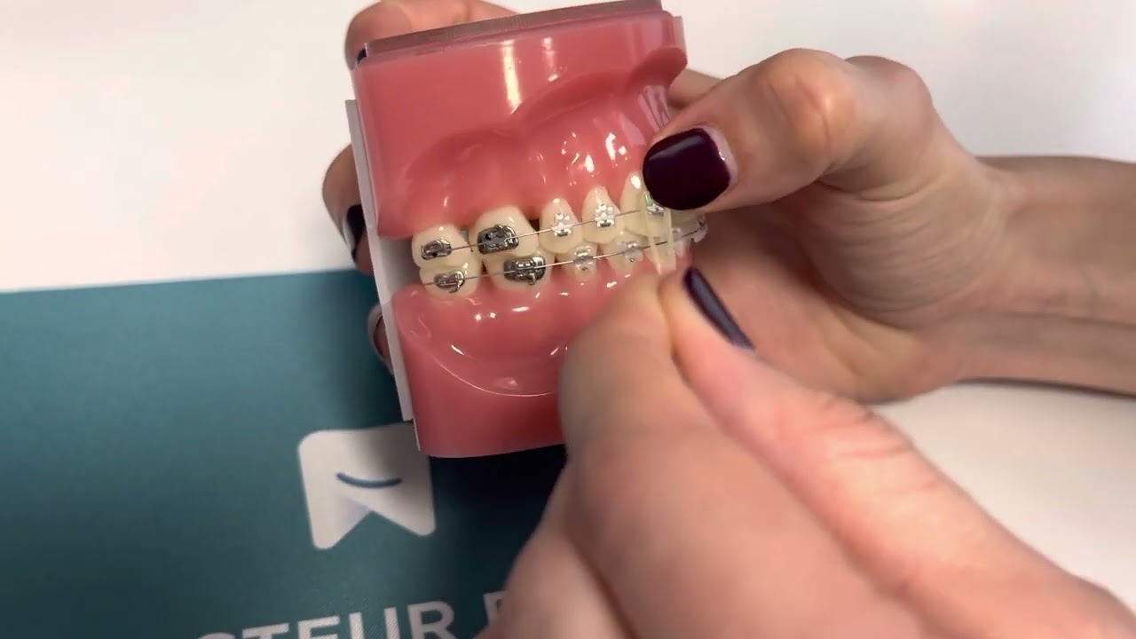 Port des élastiques en TIM 2 verticaux