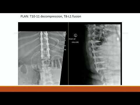 Update on Adult Thoracolumbar Spine Trauma - Major William R.Y. Carlton, MD
