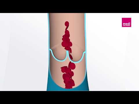 So entsteht eine Thrombose und in der Folge eine Lungenembolie