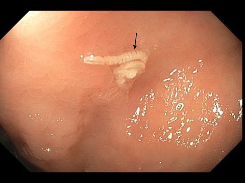 Pinworms Explained 🪱 Symptoms, Diagnosis & Treatment of Enterobius Vermicularis