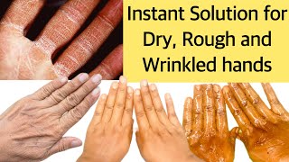 SAY GOODBYE TO DRY, ROUGH AND WRINKLED HANDS FAST (BY USING THIS REMEDY | SOFT BABY HANDS)