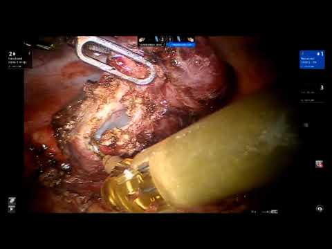 Robotic Excision of Paraesophageal Bronchogenic Cyst