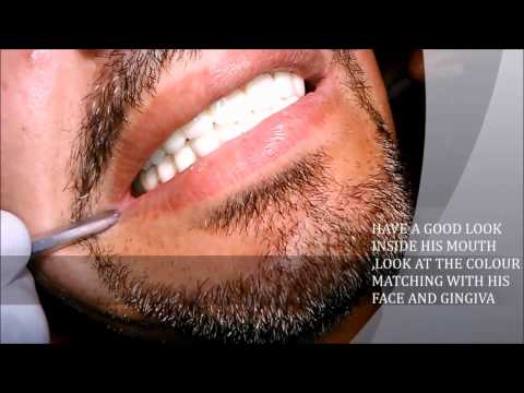 zirconium crown (zirconia) a full mouth case with dr.amithsingh- india -lucknow -aliganj