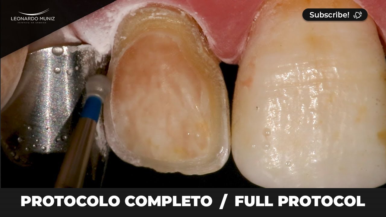 Preparación para Carillas en Dientes Oscuros: Protocolo completo