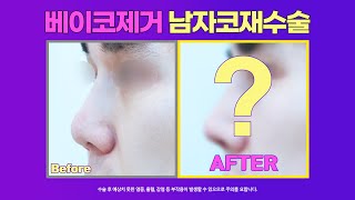 남자코재수술 : 베이코제거 이물질제거 후 남자코수술