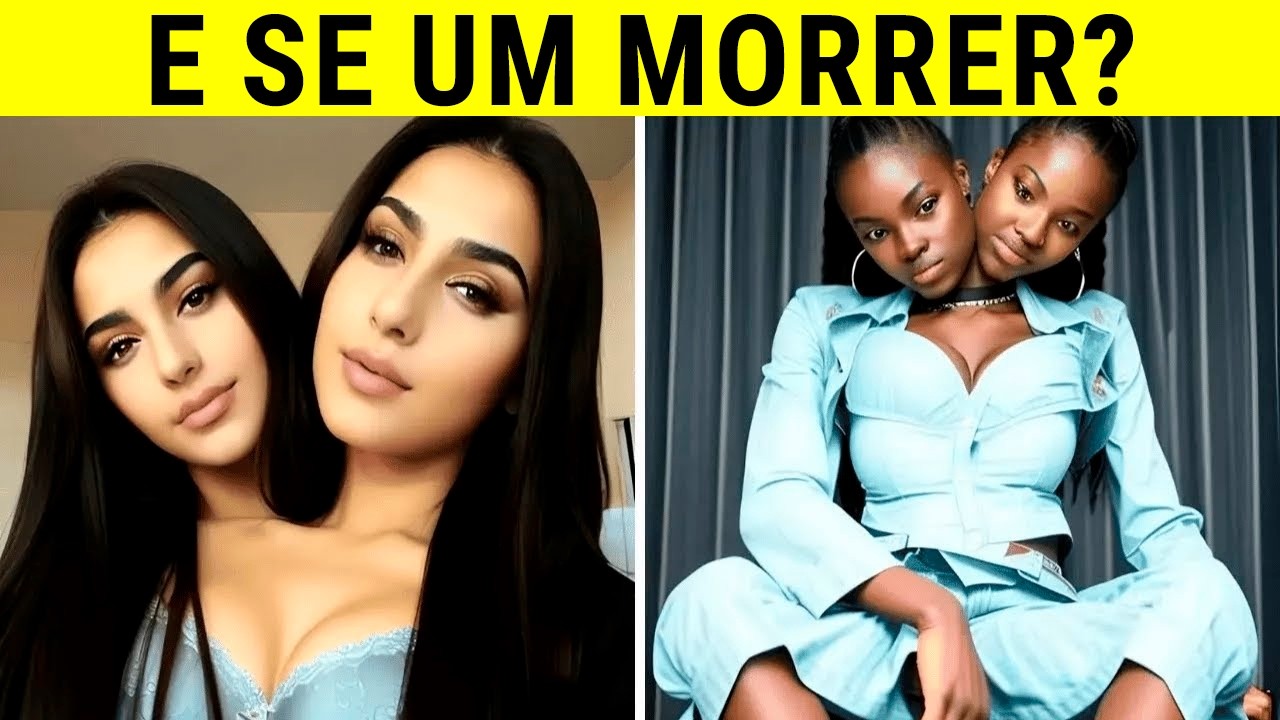 12 Gêmeos Siameses Que Você Não Vai Acreditar Que Existem