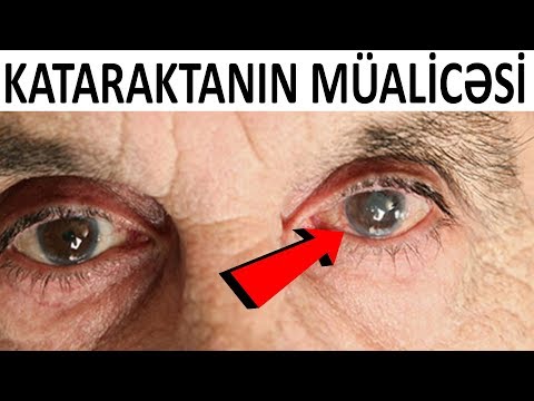 Katarakta nədir və necə müalicə olunur?