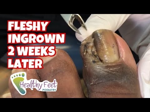 Fleshy Ingrown Toenail Removal 2 Weeks Later