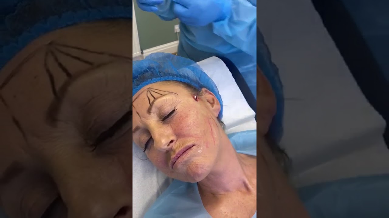 Training Face lift PDO 3 - Professional Aesthetics Academy