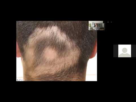 Global Dermatology Talks 9-13-2021 - Ramon Grimalt MD