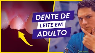 É NORMAL UM ADULTO TER DENTE DE LEITE | VERDADE REVELADA!