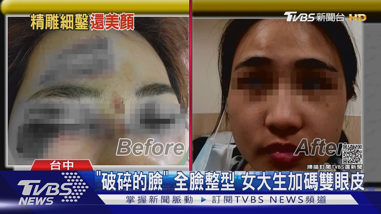 車禍撞成「破碎的臉」女大生　全臉整型手術加碼雙眼皮