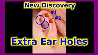 Crusty Itchy Ear - Ears Have 4 Extra Holes Liquid Otitis Externa Staphylococcus Dermatitis Psoriasis