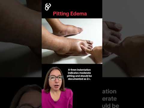 Pitting Edema: Health Assessment SHORT | @LevelUpRN