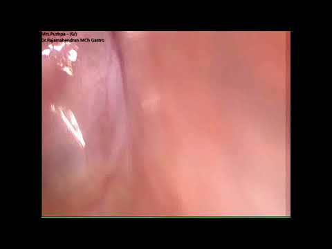 Lap Cholecystectomy RRM Video