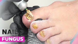 Onychomycosis | How to Deal with Nail Fungus