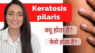 Keratosis Pilaris Treatment | Causes | Precautions | How to improve | Dermatologist recommends