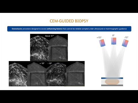 Mammography Guided Breast Interventions - BD Europe