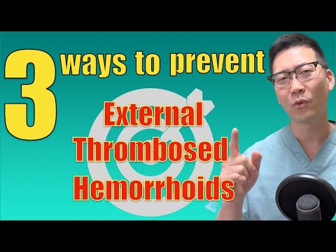 How to PREVENT External Thrombosed Hemorrhoids | Hemorrhoids, anal fissure