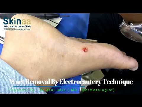 Foot Wart Removal by Electrocautery | Skinaa Clinic | Jaipur