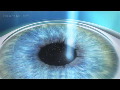 Augenlasern mit dem Verfahren PRK