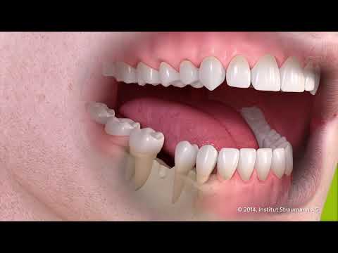 Wie funktioniert ein Zahnimplantat Köln? Einzel-Zahn-Implantat?