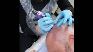 Density SMP Scalp Micropigmentation by El Truchan @ Perfect Definition
