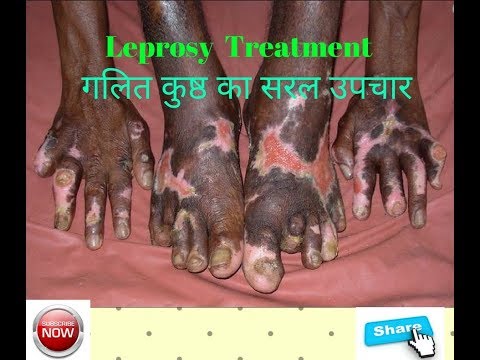 गलित कुष्ठ का उपचार/leprosy treatment/safed daag ka ilaj/indian ayurveda channel Video