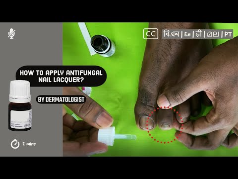 💅 How to apply antifungal nail lacquer to nail fungus?  |  by Dermatologist
