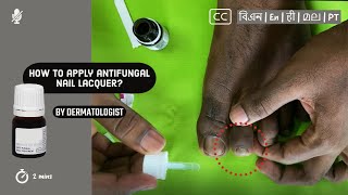 💅 How to apply antifungal nail lacquer to nail fungus?  |  by Dermatologist