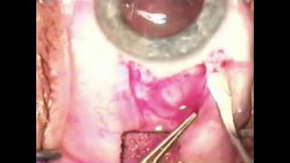 Marty Spencer - Neutral Incision b