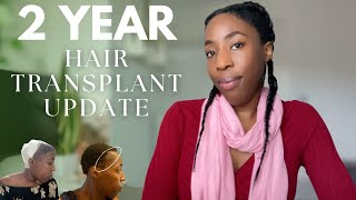 2 YEARS AFTER HAIR TRANSPLANT RESULTS (FUE PROCEDURE TURKEY 🇹🇷💉)