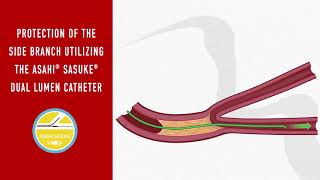 Side Branch Protection: Dual-Lumen Tutorial