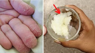 Fix dry, severely  cracked hands and skin peeling from fingers naturally at home
