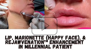 Lip, Marionette (Happy Face), & reJAWvenation™ Enhancement In Millennial Patient
