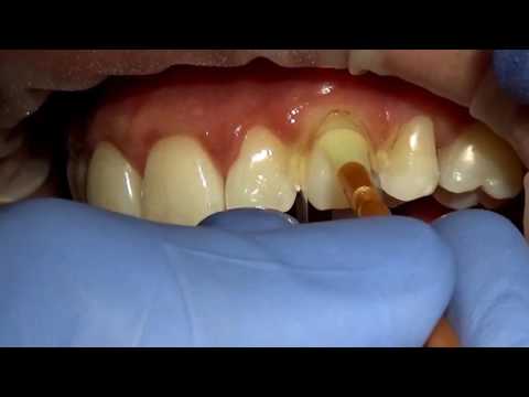 Περιαυχενικό Τεχνητό Τοίχωμα - Contour Strip - Επίδειξη Live (Dental TTT - Webinar No 6Β).