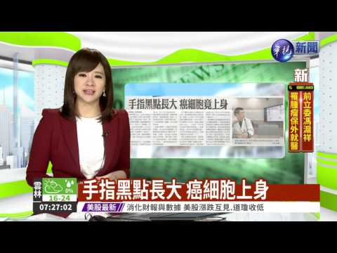 手指黑點長大 癌細胞上身