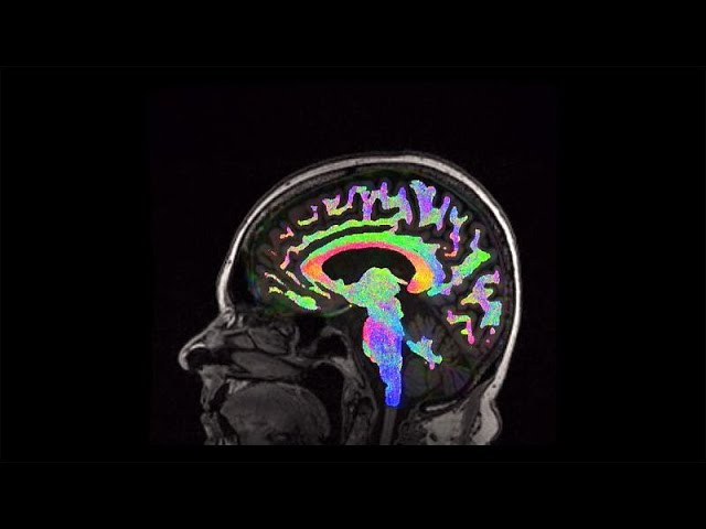 Vídeo relacionado con El Camino Hacia La Recuperacion: Una guía sobre lesiones cerebrales para familias