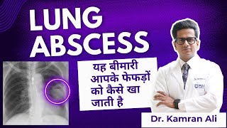 Lung Abscess क्या है ? || Diagnosis & Treatment