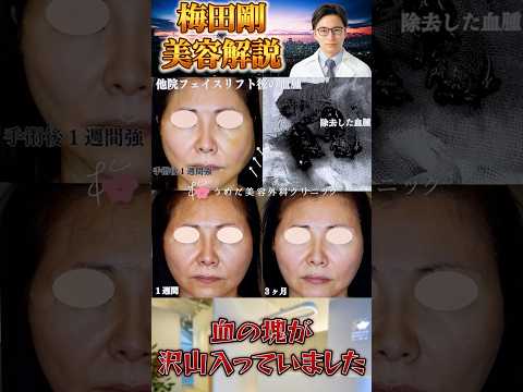 医学科 他院フェイスリフト後の血腫 #うめだ美容外科クリニック #フェイスリフト #血腫