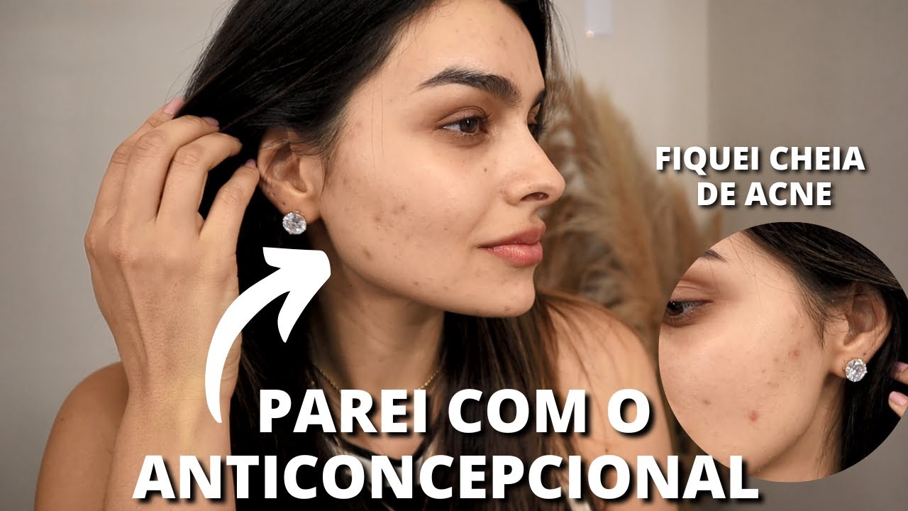 DESCOBRI QUE TENHO SOP: SÍNDROME DO OVÁRIO POLICÍSTICO | FIQUEI CHEIA DE ACNE!