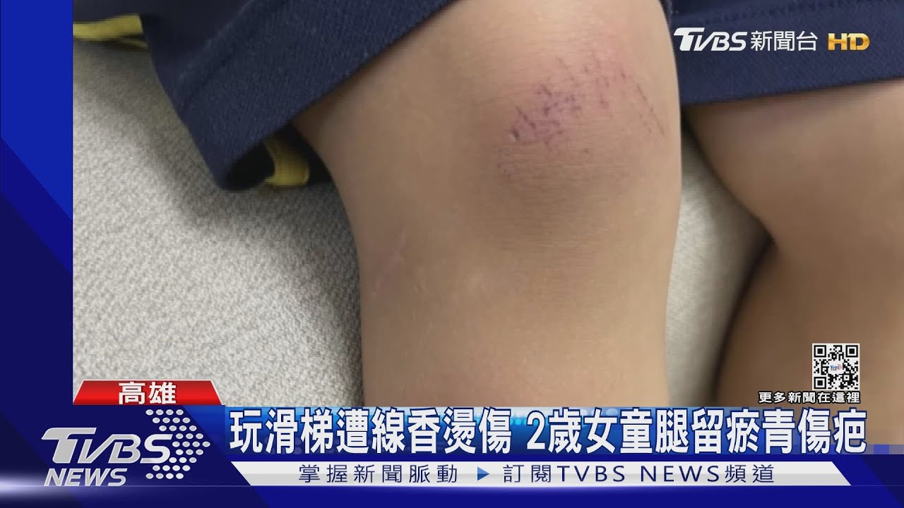 公園玩滑梯遭線香燙傷！2歲女童腿留瘀青深疤