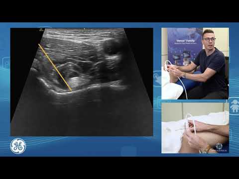 Anterior hip, iliospoas and rectus femoris for POCUS clinicians
