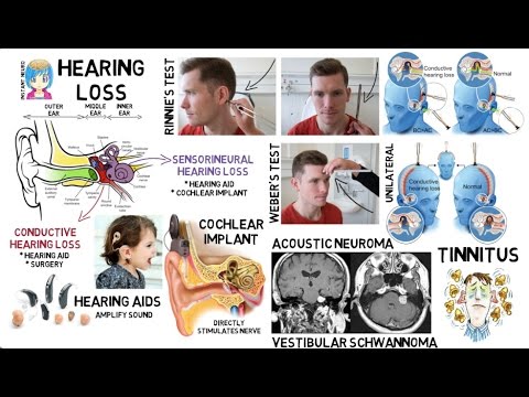 INSTANT NEURO - Hearing loss