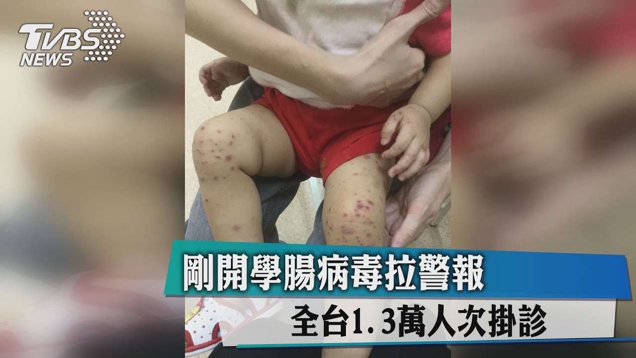 剛開學腸病毒拉警報　全台1.3萬人次掛診