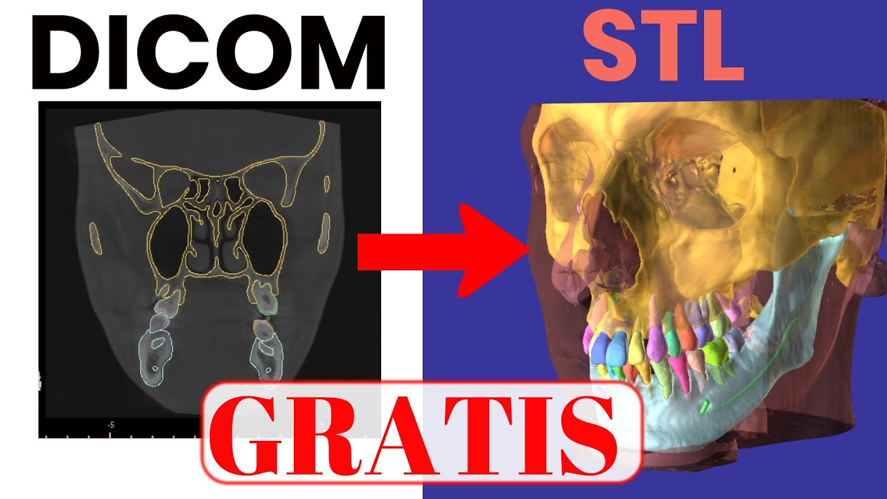 Convertir DICOM a STL Gratis- Inteligencia artificial Blue Sky Plan