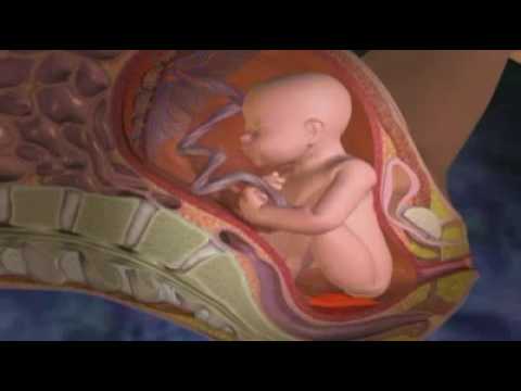 Hématome rétroplacentaire ou Décollement placentaire