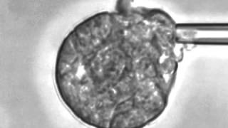 Frustrated phagocytosis of a mature C. posadasii spherule by a human neutrophil.
