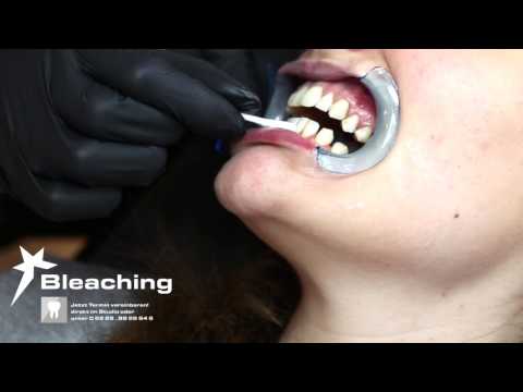 Bleaching/Zahnaufhellung in Bruchmühlen