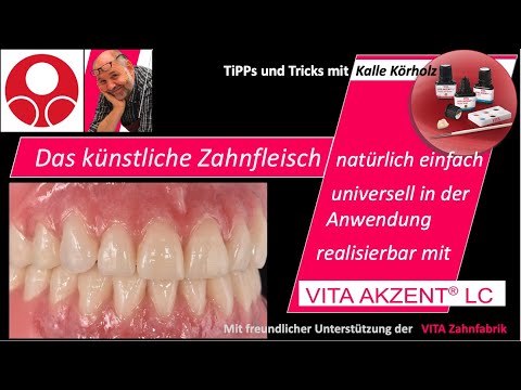 Das künstliche Zahnfleisch individualisieren mit VITA Akzent LC